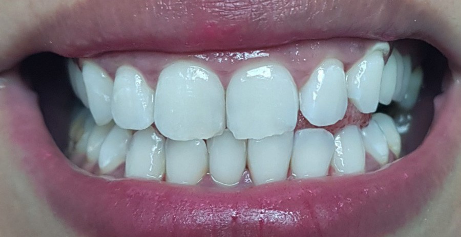 Before Whitening-Laser 5